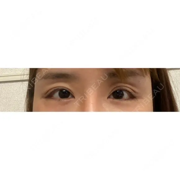 目尻靭帯移動 ヴェリテクリニック 銀座院 DAY 21 メイン用