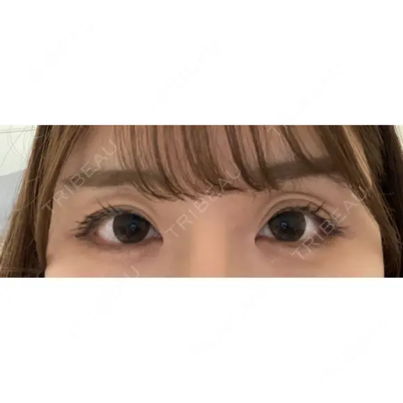 目尻靭帯移動 ヴェリテクリニック 銀座院 DAY 30 メイン用