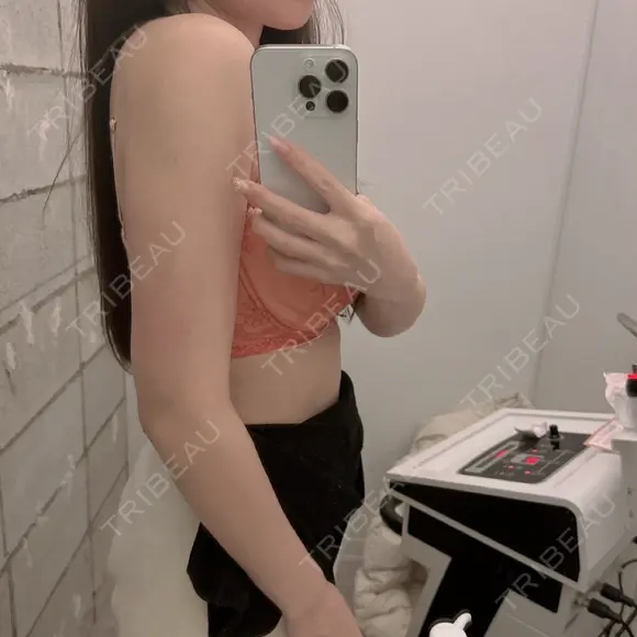 脂肪吸引（二の腕） アムルーズ美容外科クリニック 大阪院 DAY 36 メイン用