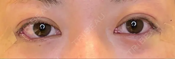 目頭切開 / タレ目形成・グラマラスライン（埋没） LOUIS CLINIC 二子玉川院【ルイクリニック】 DAY 0 メイン用