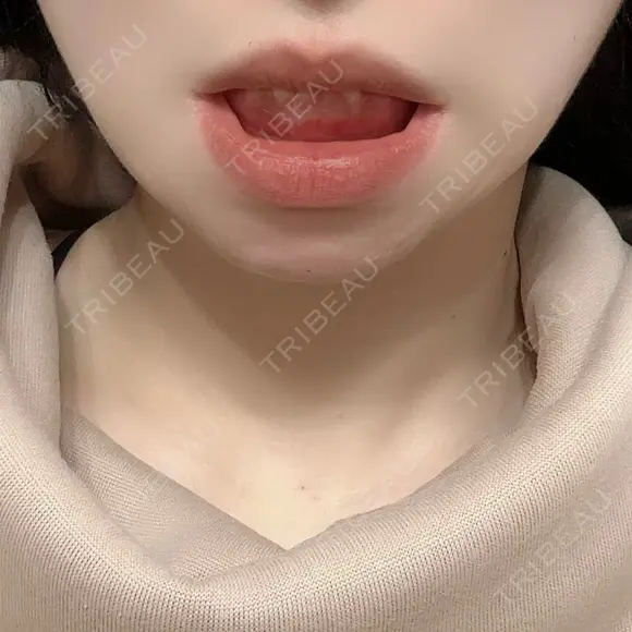 骨切り（あご） / 輪郭修正 / 脂肪溶解注射（顔） 心斎橋コムロ美容外科クリニック DAY 1927 メイン用