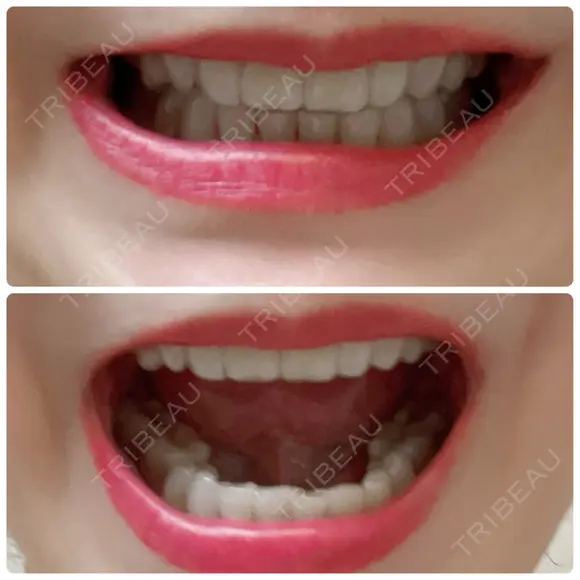 その他（審美歯科/矯正歯科） / 矯正（ワイヤー） / セラミック アニバーサリーデンタルギンザ DAY 1449 メイン用