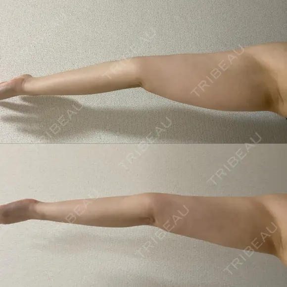 脂肪吸引（二の腕） / 脂肪吸引（肩） Mods Clinic（モッズクリニック） 大阪院 DAY 29 メイン用