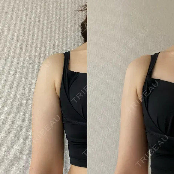 脂肪吸引（二の腕） / 脂肪吸引（肩） Mods Clinic（モッズクリニック） 大阪院 DAY 29 メイン用