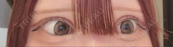 二重切開 / 目頭切開 / 眼瞼下垂（切開） オーキッド美容クリニック東京御徒町 DAY 55 メイン用