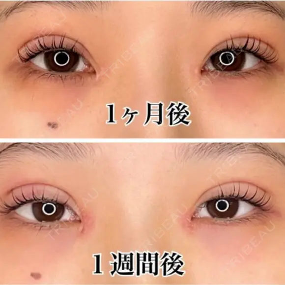 二重埋没 / 目頭切開 城本クリニック 長崎院 DAY 132 メイン用