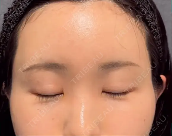 クマ治療 / こめかみ形成 / 脂肪注入（額） / 脂肪注入（目の下） / ボトックス（額） X CLINIC 銀座院 DAY 25 メイン用