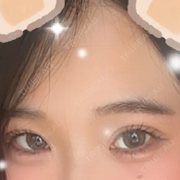 ヒアルロン酸注入（涙袋） 城本クリニック 長崎院 AFTER メイン用