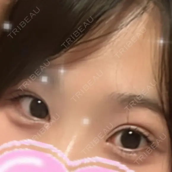 ヒアルロン酸注入（涙袋） 城本クリニック 長崎院 DAY 359 メイン用