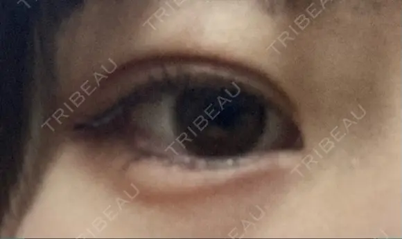 二重埋没 湘南美容クリニック 町田院 AFTER メイン用