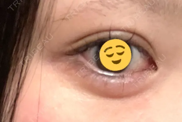 ヒアルロン酸注入（涙袋） / ヒアルロン酸注入（唇） 東京シンデレラ美容外科 大宮院 AFTER メイン用