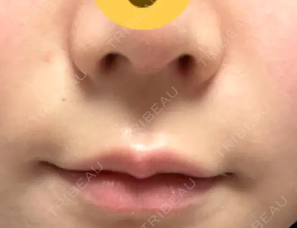 ヒアルロン酸注入（涙袋） / ヒアルロン酸注入（唇） 東京シンデレラ美容外科 大宮院 DAY 23 メイン用