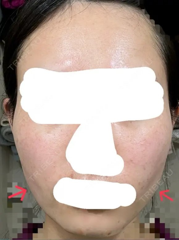 糸リフト / 脂肪吸引（顔） / ジョールファット除去 / ボトックス（エラ・小顔） ルラ美容クリニック 新宿院 AFTER メイン用