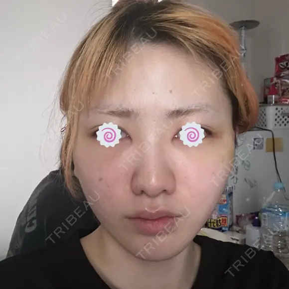 切開リフト 東京エビスクリニック DAY 4 メイン用