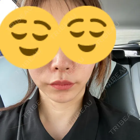 ボトックス（エラ・小顔） ルラ美容クリニック 大宮院 / ルラスキンクリニック 大宮院 DAY 14 メイン用