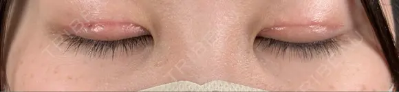 二重切開 / 目頭切開 / 上まぶたたるみ取り アリエル美容クリニック 大宮院 DAY 32 メイン用