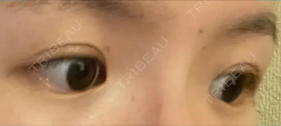 二重埋没 水の森美容クリニック 大阪梅田院 DAY 9 メイン用