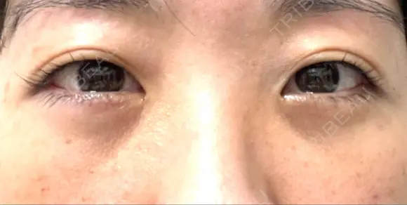 クマ治療 湘南美容クリニック 千葉センシティ院 DAY 8 メイン用
