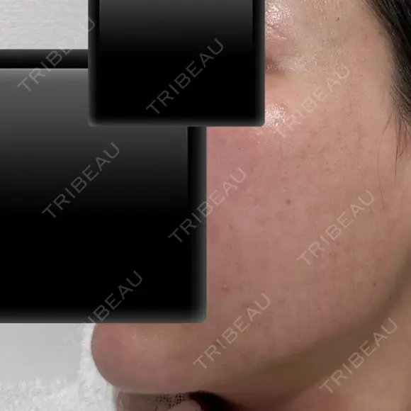 ポテンツァ ARTE BEAUTY CLINIC AFTER メイン用