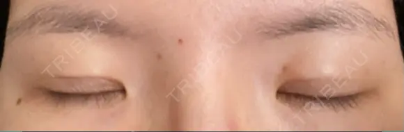 二重埋没 水の森美容クリニック 大阪梅田院 DAY 10 メイン用