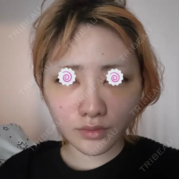 切開リフト 東京エビスクリニック DAY 5 メイン用