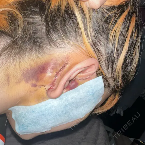 切開リフト 東京エビスクリニック DAY 5 メイン用