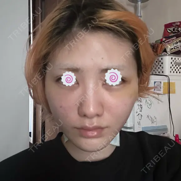 切開リフト 東京エビスクリニック DAY 6 メイン用