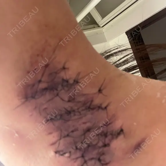 ワキ汗治療（切開） 石倉クリニック 水戸院 DAY 1 メイン用