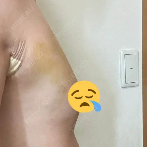 豊胸（脂肪注入） 銀座マイアミ美容外科 DAY 3 メイン用