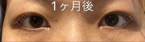 目頭切開 LUHO（ルホ）美容外科 DAY 30 メイン用