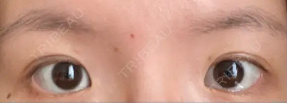 二重埋没 水の森美容クリニック 大阪梅田院 DAY 12 メイン用