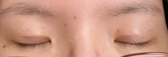 二重埋没 水の森美容クリニック 大阪梅田院 DAY 12 メイン用