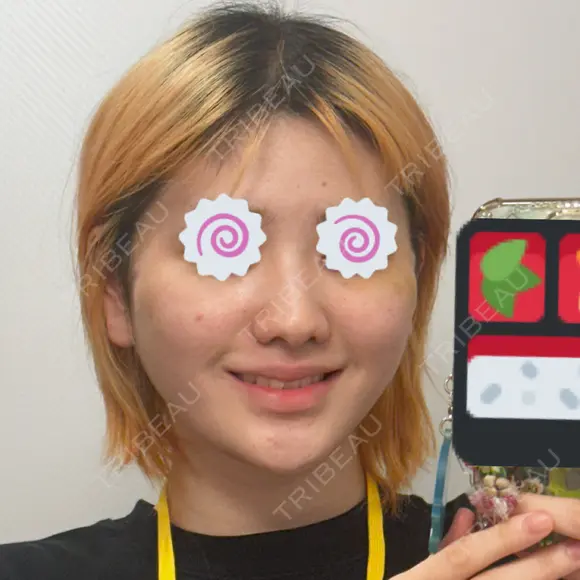 切開リフト 東京エビスクリニック DAY 7 メイン用