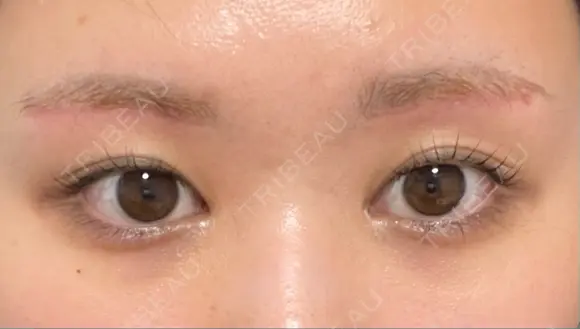 眼瞼下垂（切開） 水の森美容クリニック 福岡院 AFTER メイン用