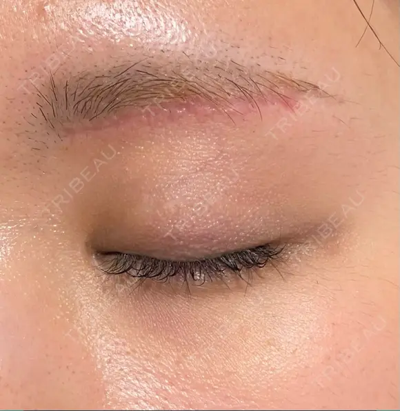 眼瞼下垂（切開） 水の森美容クリニック 福岡院 DAY 77 メイン用