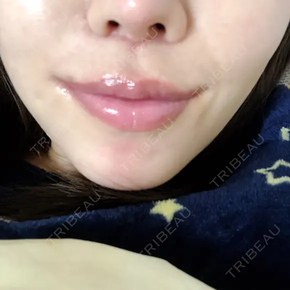 人中短縮 / 口唇縮小術 / 口角挙上 HB整形外科 DAY 23 メイン用
