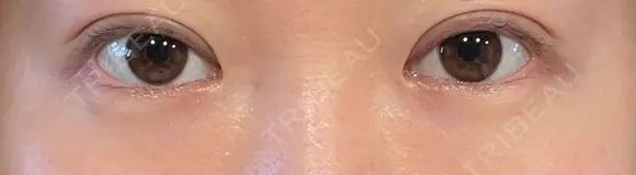 二重切開 Olino美容外科・美容皮膚科 DAY 23 メイン用