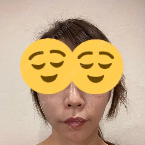 ボトックス（エラ・小顔） ルラ美容クリニック 大宮院 / ルラスキンクリニック 大宮院 DAY 18 メイン用