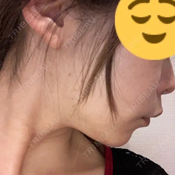 ボトックス（エラ・小顔） ルラ美容クリニック 大宮院 / ルラスキンクリニック 大宮院 DAY 18 メイン用