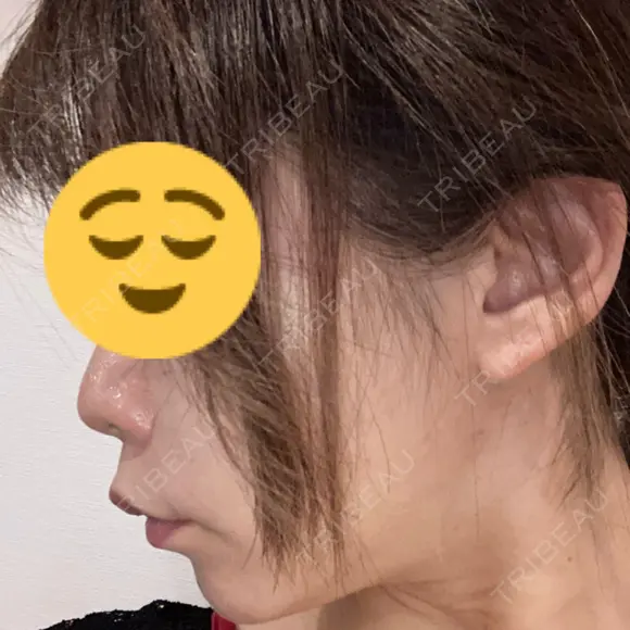 ボトックス（エラ・小顔） ルラ美容クリニック 大宮院 / ルラスキンクリニック 大宮院 DAY 18 メイン用