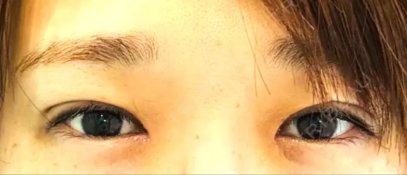 目頭切開 / 自然癒着法 / 眼瞼下垂（非切開） LUHO（ルホ）美容外科 DAY 0 メイン用
