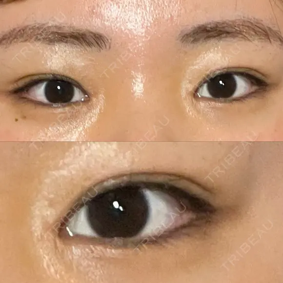 目頭切開 湘南美容クリニック 大阪心斎橋院 AFTER メイン用