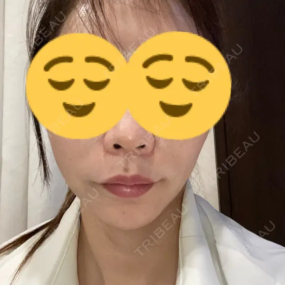 ボトックス（エラ・小顔） ルラ美容クリニック 大宮院 / ルラスキンクリニック 大宮院 AFTER メイン用