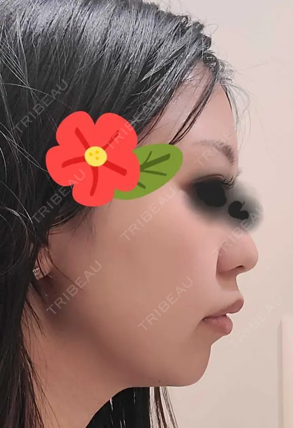ヒアルロン酸注入（あご） / シワ取りボトックス ブルームクリニック（BLOOM CLINIC） DAY 0 メイン用