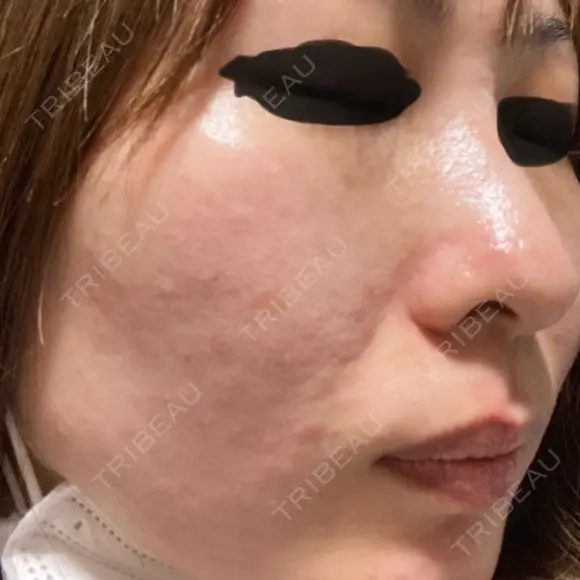 美肌レーザー / ピコレーザートーニング（美白・肝斑） CLINIC W DAY 1 メイン用