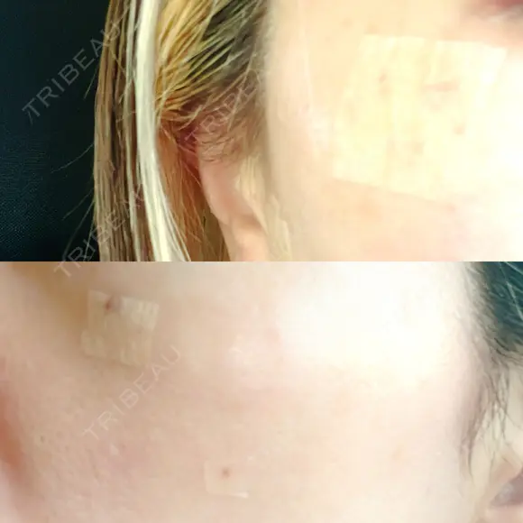 ルビーレーザー S-Laboクリニック 渋谷院 DAY 1 メイン用