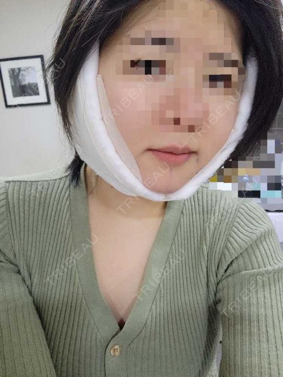 糸リフト / 脂肪吸引（顔） / あご下筋肉縛り / 脂肪注入（輪郭） セギム美容整形外科 DAY 0 メイン用