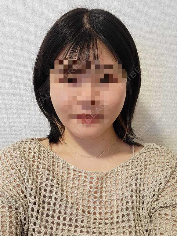 糸リフト / 脂肪吸引（顔） / あご下筋肉縛り / 脂肪注入（輪郭） セギム美容整形外科 AFTER メイン用