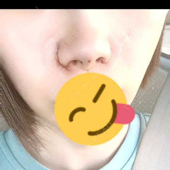 小鼻縮小（切開） / 鼻尖形成（非切開） / その他（鼻） CLINIC W DAY 0 メイン用