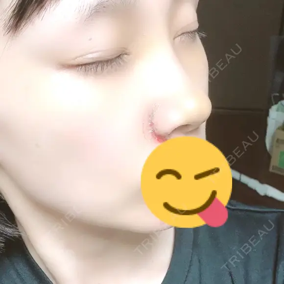 小鼻縮小（切開） / 鼻尖形成（非切開） / その他（鼻） CLINIC W DAY 3 メイン用